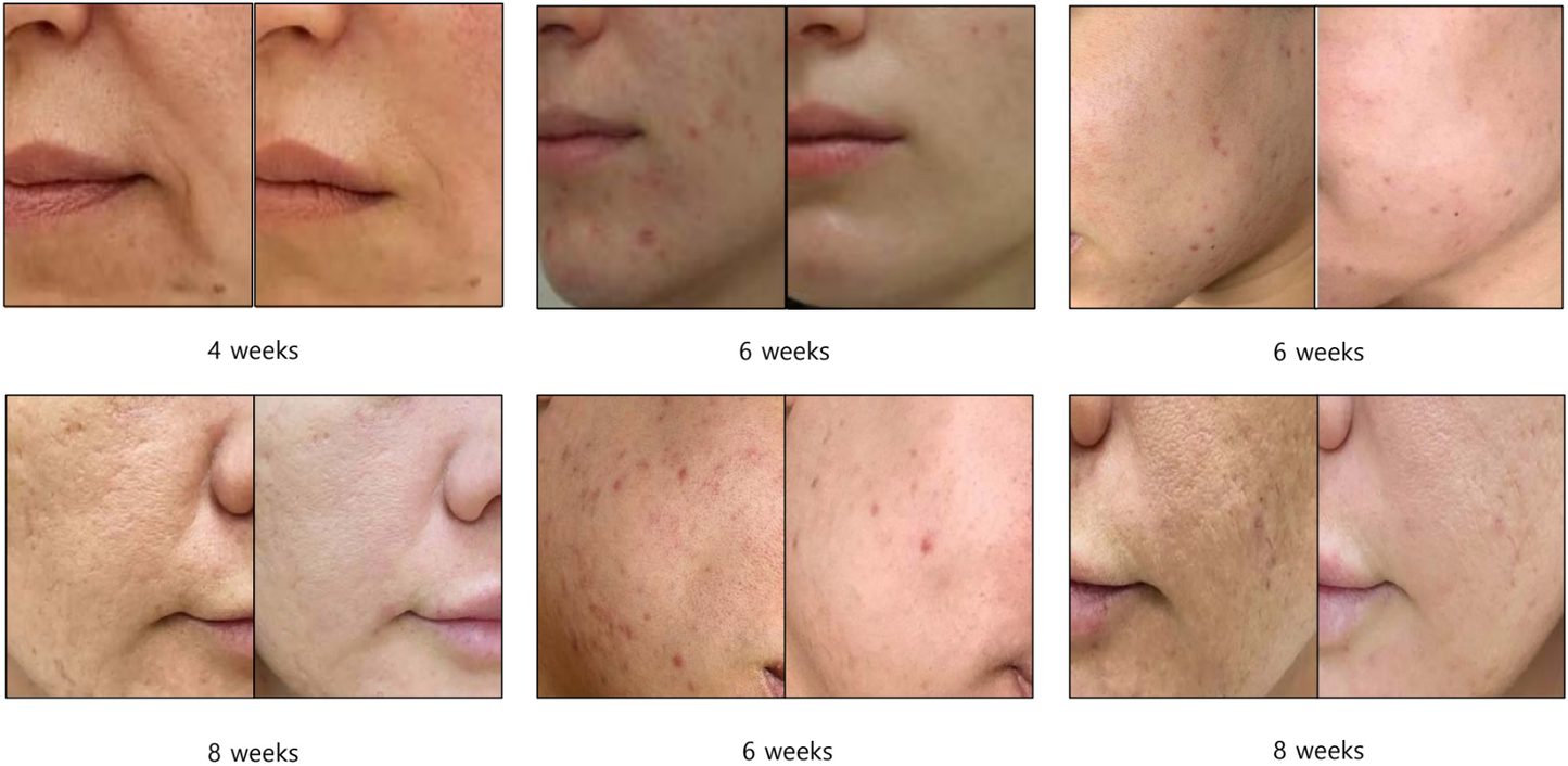 DUOLIF 2-in-1 HIFU (3mm) + RF gezichtslift apparaat