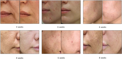 DUOLIF 2-in-1 HIFU (3mm) + RF gezichtslift apparaat